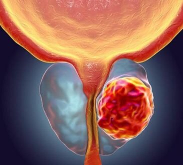 cura de cáncer de próstata